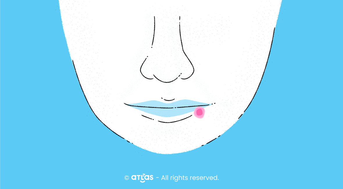Herpes Simplex | Implicații, complicații, soluții
