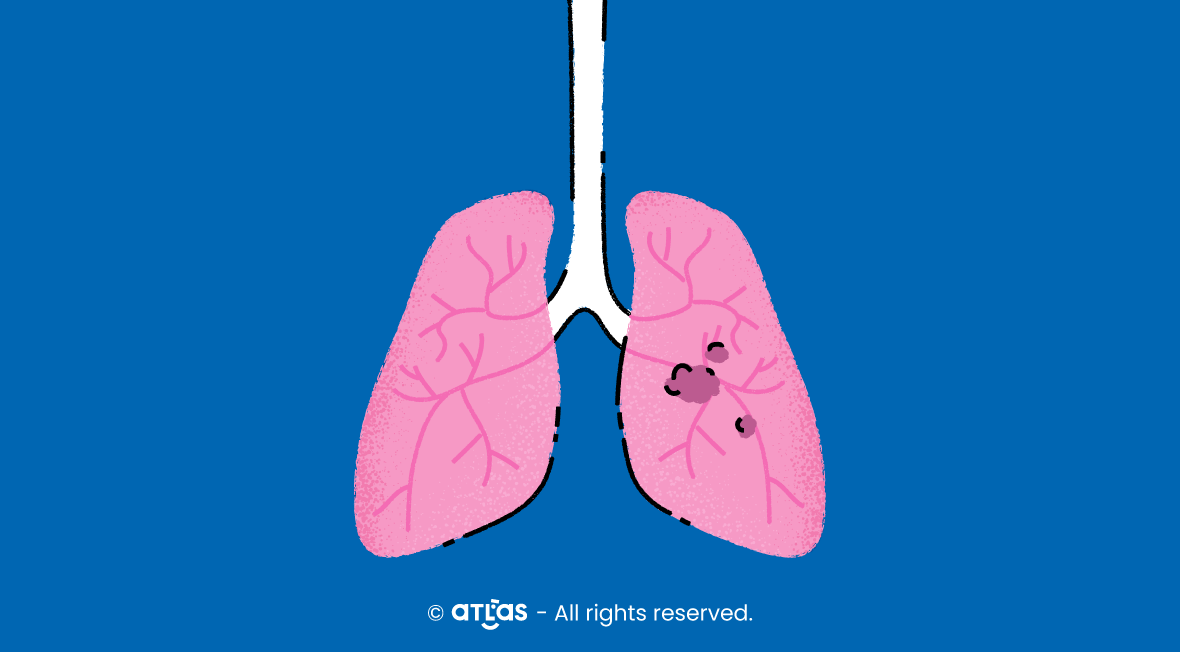 Cancer pulmonar simptome, tratament